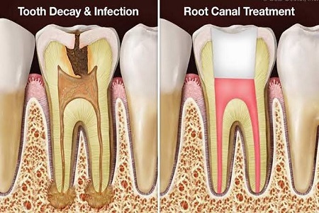 Root Canal Treatment (Rct)